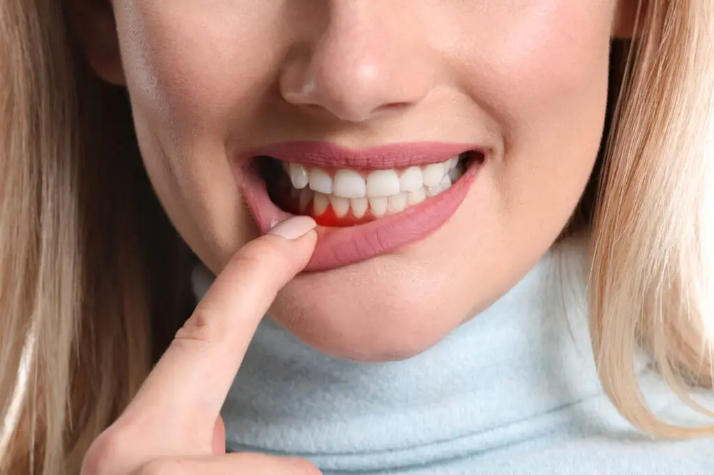 Gum Grafting in Stevensville, MD: When Receding Gums Need Treatment Gum Grafting in Stevensville, MD: When Receding Gums Need Treatment