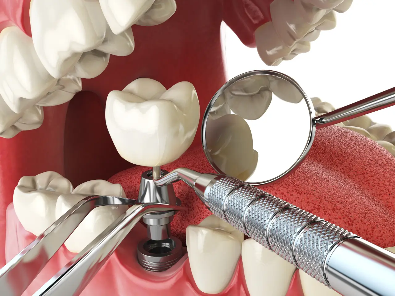 Dental Implants in Stevensville, MD: What to Expect From Consultation to Recovery